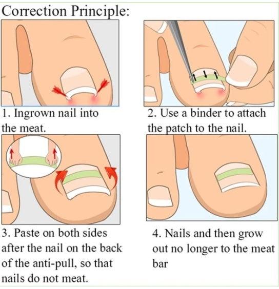 Nail patch - MAXIME