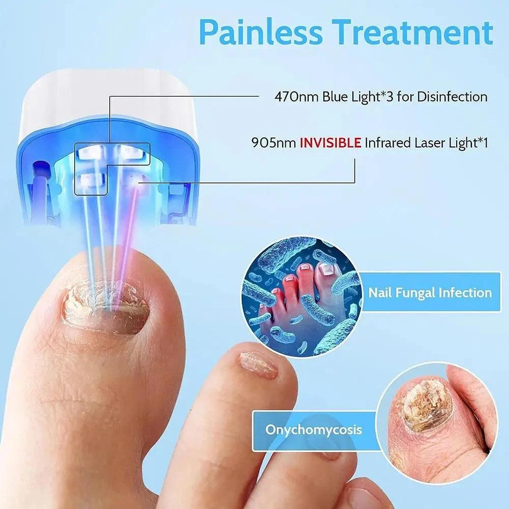 Maxime Nail Fungus Laser Treatment Device Repair Toenail Fingernail Fungus Treat Onychomycosis Therapy Cure Machine Effectively Remove - MAXIME