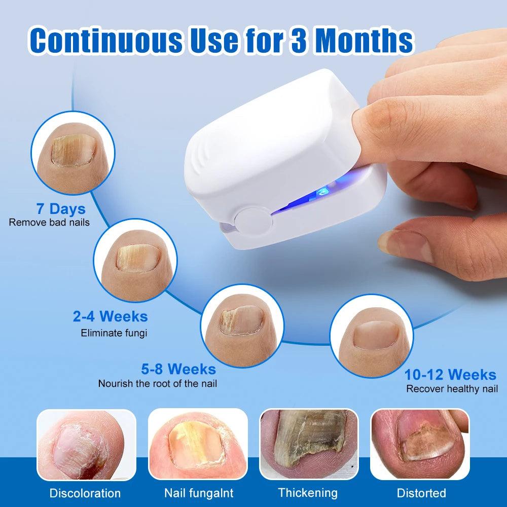 Maxime Nail Fungus Laser Treatment Device Repair Toenail Fingernail Fungus Treat Onychomycosis Therapy Cure Machine Effectively Remove - MAXIME