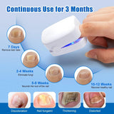 Maxime Nail Fungus Laser Treatment Device Repair Toenail Fingernail Fungus Treat Onychomycosis Therapy Cure Machine Effectively Remove - MAXIME